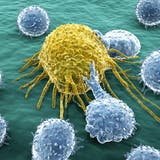 Lymphozyten attackieren eine Krebszelle. Ihre raffinierte Abwehr zu überwinden ist das Ziel der Immuntherapie. (Bild:  Getty/Science Photo Library)