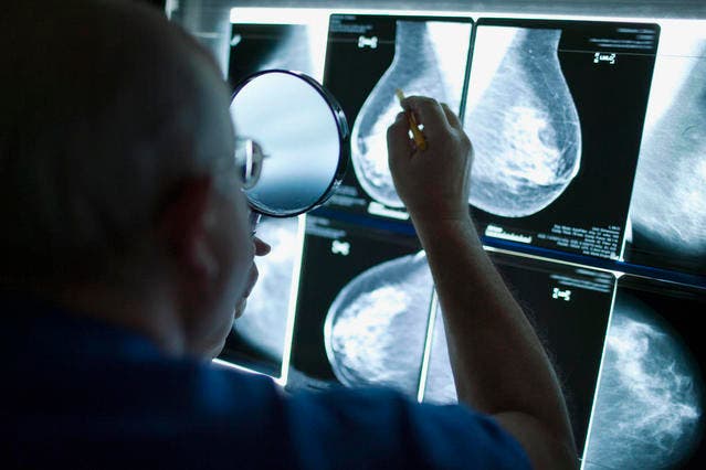 Ein Arzt untersucht das Mammografie-Ergebnis auf Brustkrebs. (Symbolbild: Gaetan Bally/Keystone)