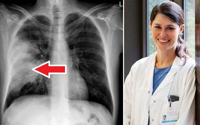 Auf dem Röntgenbild erkennt man einen grossen weissen Fleck (Pfeil) – dieser zeigt, dass es sich um eine Lungenentzündung handelt. Dank Kortison können betroffene Patienten eineinhalb Tage früher aus dem Spital entlassen werden.