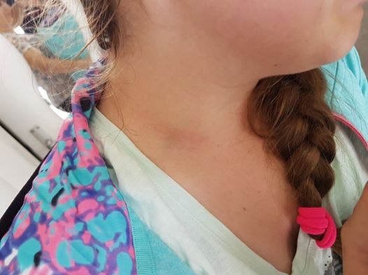 Ein Vater aus Buchs hat auf Facebook einen Fahndungsaufruf nach einen Mann gestartet, der sich an seiner Tochter vergriffen hat. Das Bild zeigt Rötungen am Hals des Mädchens.