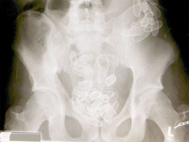 Auf Röntgenbild ersichtliche verschluckte Fingerlinge (Symbolbild)