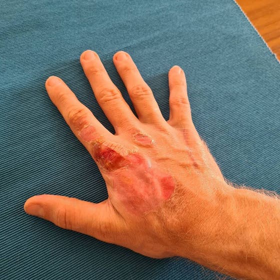 Nach Ublem Crash So Sieht Die Verbrannte Hand Von Romain Grosjean Aus