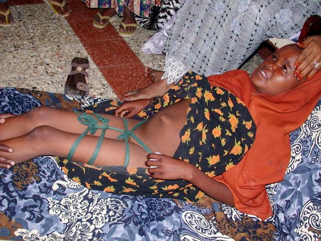 Genitalverstümmelung beeinträchtigt nicht nur schwer die Gesundheit betroffenen Mädchen und Frauen, sie belastet auch die Gesundheitsbudgets der Länder, in denen diese Praxis verbreitet ist. Auf dem Bild ein 9-jähriges Mädchen einige Tage nachdem ihre Genitalien verstümmelt wurden.