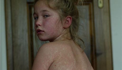 Masern - Für die Ausrottung der Masern müssen ungeimpfte Kinder daheim  bleiben