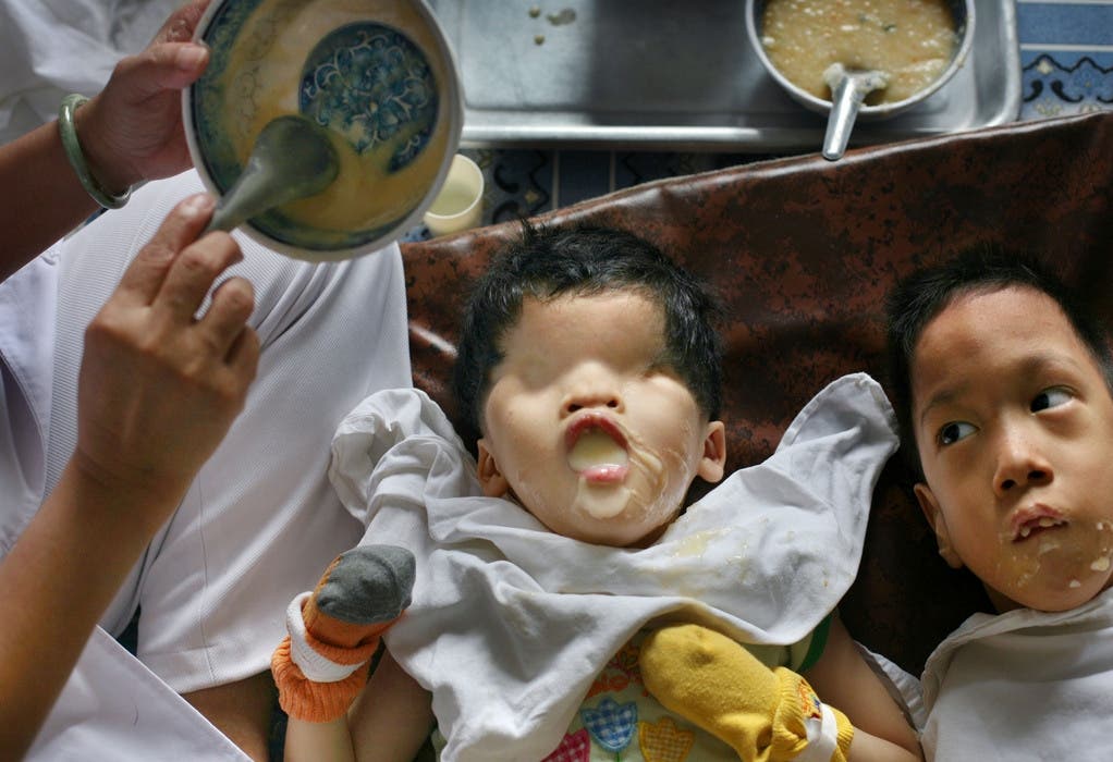 Dieses fünf Jahre alte Mädchen ist ein Opfer von Agent Orange und ohne Augen geboren worden – Foto von 2007