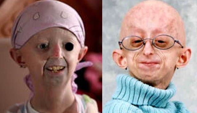 Sehen aus wie Greise, sind aber noch Kinder: Opfer der seltenen Krankheit Progerie.