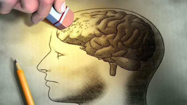 95 Prozent der Dementen sind von Alzheimer betroffen, bei dem Nervenzellen in bestimmten Abschnitten des Gehirns absterben.
