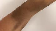 Der verfärbte Arm nach der Eisentransfusion. (Bild: zvg)