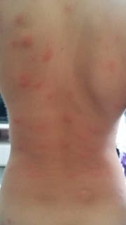 Nach dem baden im Simmi-Weiher reagierte am Mittwoch ein Mädchen mit allergischen Hautreaktionen, nachdem es von Entenflöhen gebissen worden war.