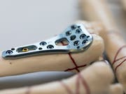 Laut internationalen Recherchen soll die Zahl der Problemfälle mit Implantaten weltweit stark zugenommen haben. (Bild: KEYSTONE/GAETAN BALLY)