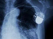 Fatale Folgen bei Fehlfunktion: Immer mehr Menschen werden durch Implantate verletzt. (Bild: Choo Chin/Getty)