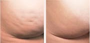 Von Cellulite betroffen Körperpartie links vor der Behandlung, rechts nach der Behandlung (Bild: Lucerne Clinic)