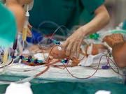 Drei Schweizer Spitäler haben fehlerhafte Produkte aus Pakistan eingesetzt - darunter auch Kanülen, die für Herzoperationen an Babys verwendet werden. (Archivbild) (Bild: KEYSTONE/GAETAN BALLY)