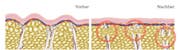 Cellulite (BIld: PD)