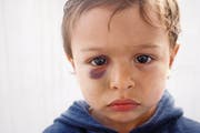 Schläge verursachen mehr als ein blaues Auge; Kinder leiden auch psychisch darunter. Das Bewusstsein dafür ist in der Schweiz zu wenig verbreitet. (Bild: Philippe Lissac/Getty)
