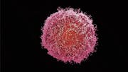 Gegen sie wirkt die Immuntherapie heute am besten: Hautkrebszelle unter dem Rasterelektronenmikroskop. (Bild: Getty)