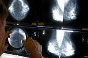 Ein Radiologe untersucht ein Bild einer Mammographie auf Krebszellen. (Bild: Damian Dovarganes/AP Keystone)