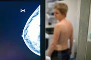 Eine Frau bei einer Vorsorgeuntersuchung, um möglichen Brustkrebs frühzeitig zu erkennen. (Bild: Keystone)