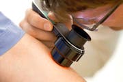 Erst ein Blick durchs Auflichtmikroskop kann einen Hautkrebs-Verdacht erhärten oder entschärfen. (Bild: Keystone)