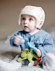 Ein Helm kann mithelfen, Kopfdeformitäten beim Kleinkind auszugleichen. (Bild: Getty)