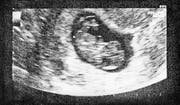 Die fötale Chirurgie wird vorangetrieben durch immer leistungsfähigere Ultraschallgeräte. (Bild: Getty)