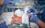 Vor wenigen Stunden geboren, muss bei dem Säugling schon Blut abgenommen werden.