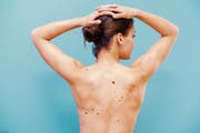 Menschen mit zahlreichen gutartigen Malen haben ein erhöhtes Risiko, an Hautkrebs zu erkranken. (Bild: Getty)