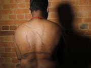 Ein politischer Flüchtling aus Sri Lanka zeigt Mitte 2017 während eines Interviews in London seine Folterspuren. Er und weitere rund 50 Tamilen gaben an, von den Sicherheitskräften des jetzigen Regimes entführt, vergewaltigt und gefoltert worden zu sein. (Bild: Keystone/AP/FRANK AUGSTEIN)
