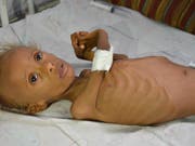 Unterernährtes Kind im Jemen: Das Kinderhilfswerk Unicef benötigt nach eigenen Angaben 3,9 Milliarden Dollar für Kinderhilfsprogramme in 59 Ländern. (Bild: KEYSTONE/AP)