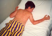 Schon bevor der typische Hautausschlag auftritt, ist eine Ansteckung möglich. Im Bild ein an Masern erkrankter Junge in einem Spital im italienischen Neapel (Bild: Keystone/AP Photo/STR, 2002).